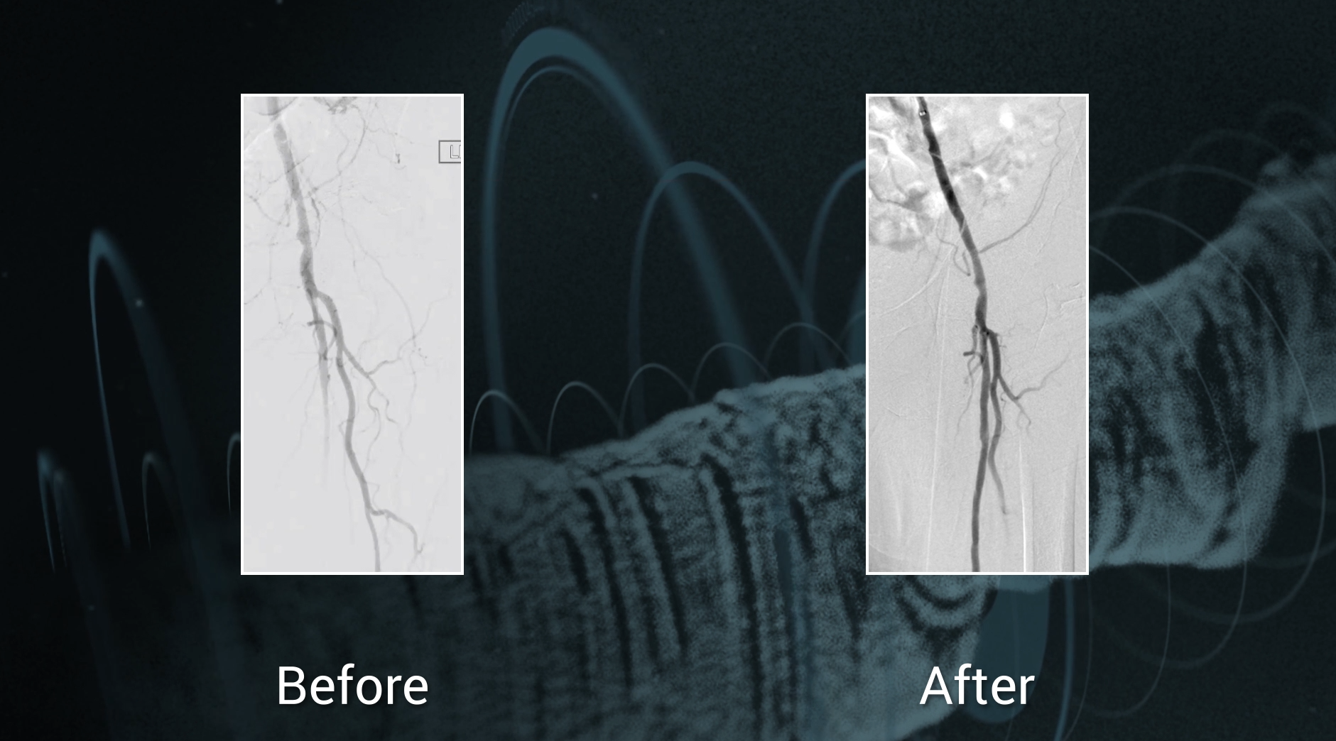 femoral popliteal artery and occlusion of tibio - peroneal trunk