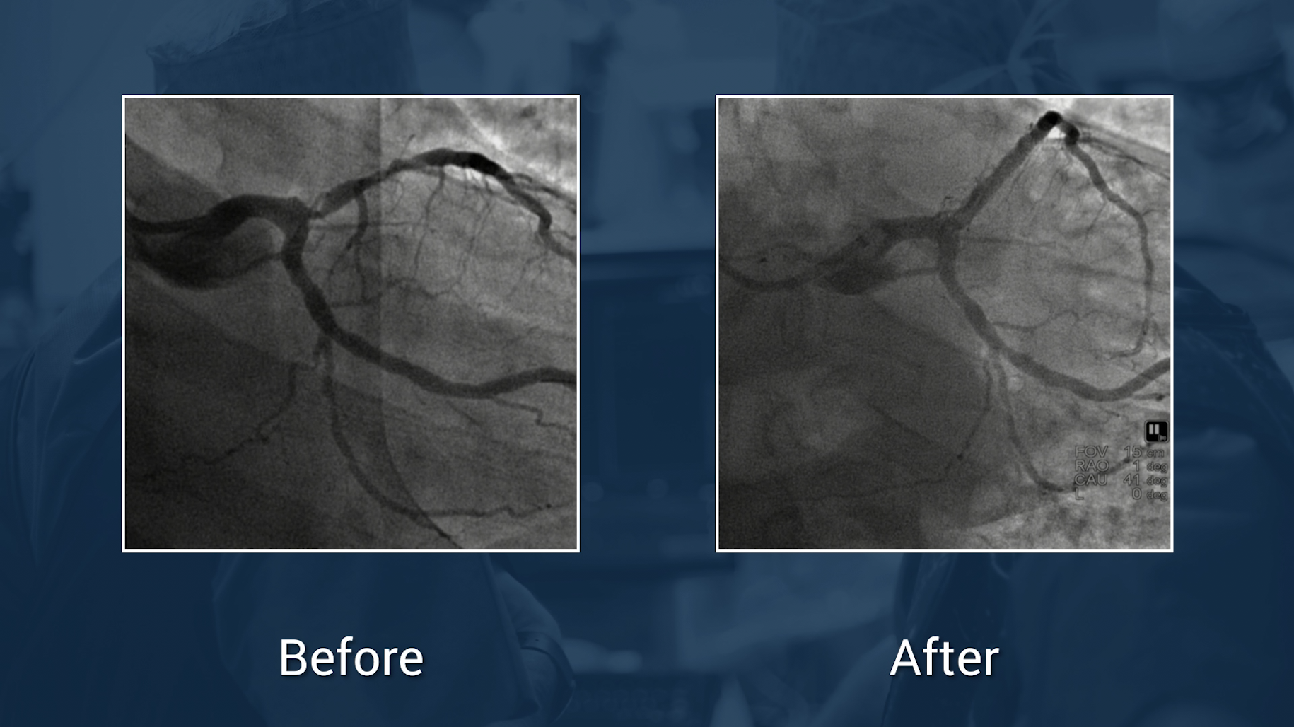 video-treatment-of-ostial-lad-lesion