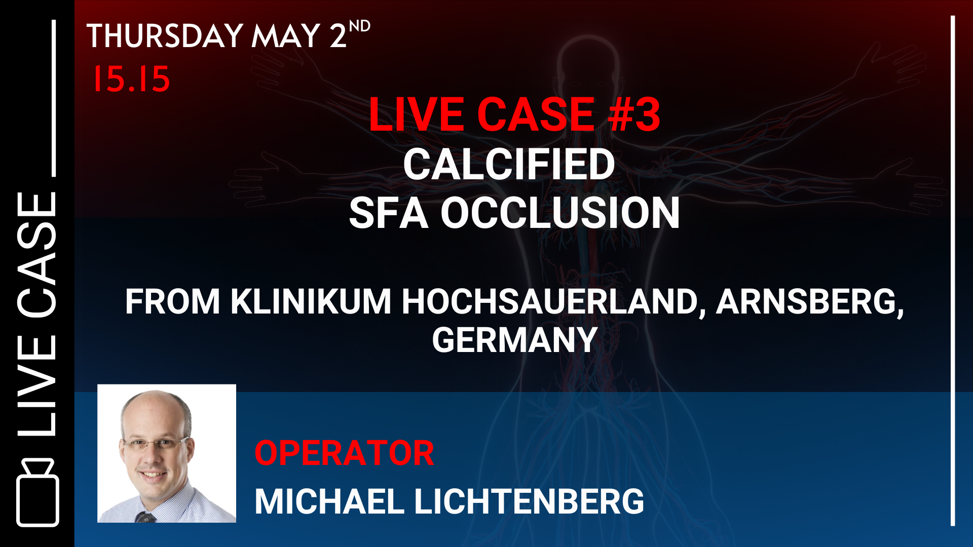 <b>Live case #3: Calcified SFA occlusion</b>